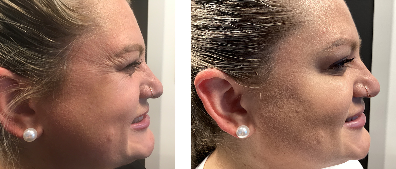 Botox in Bellevue, Washington