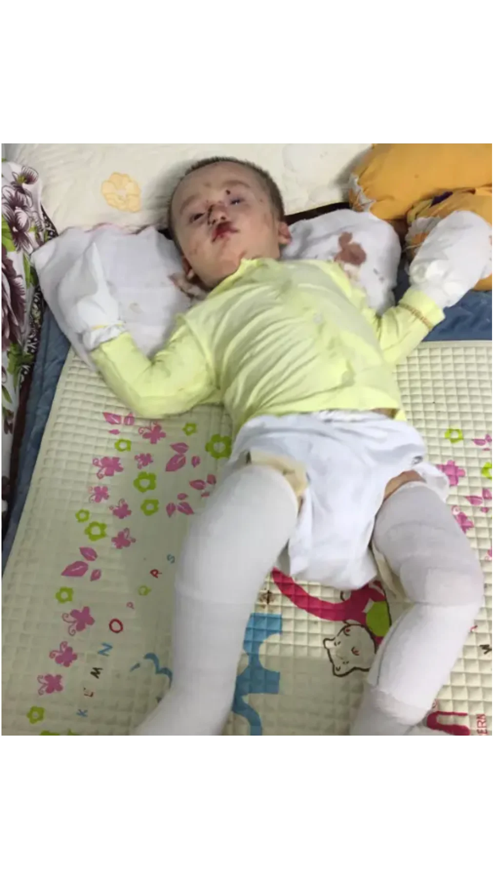 Early Signs Of Epidermolysis Bullosa: Visible & Internal Symptoms Explained